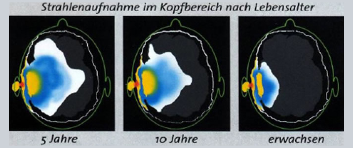 Strahlenaufnahme im Kopfbereich